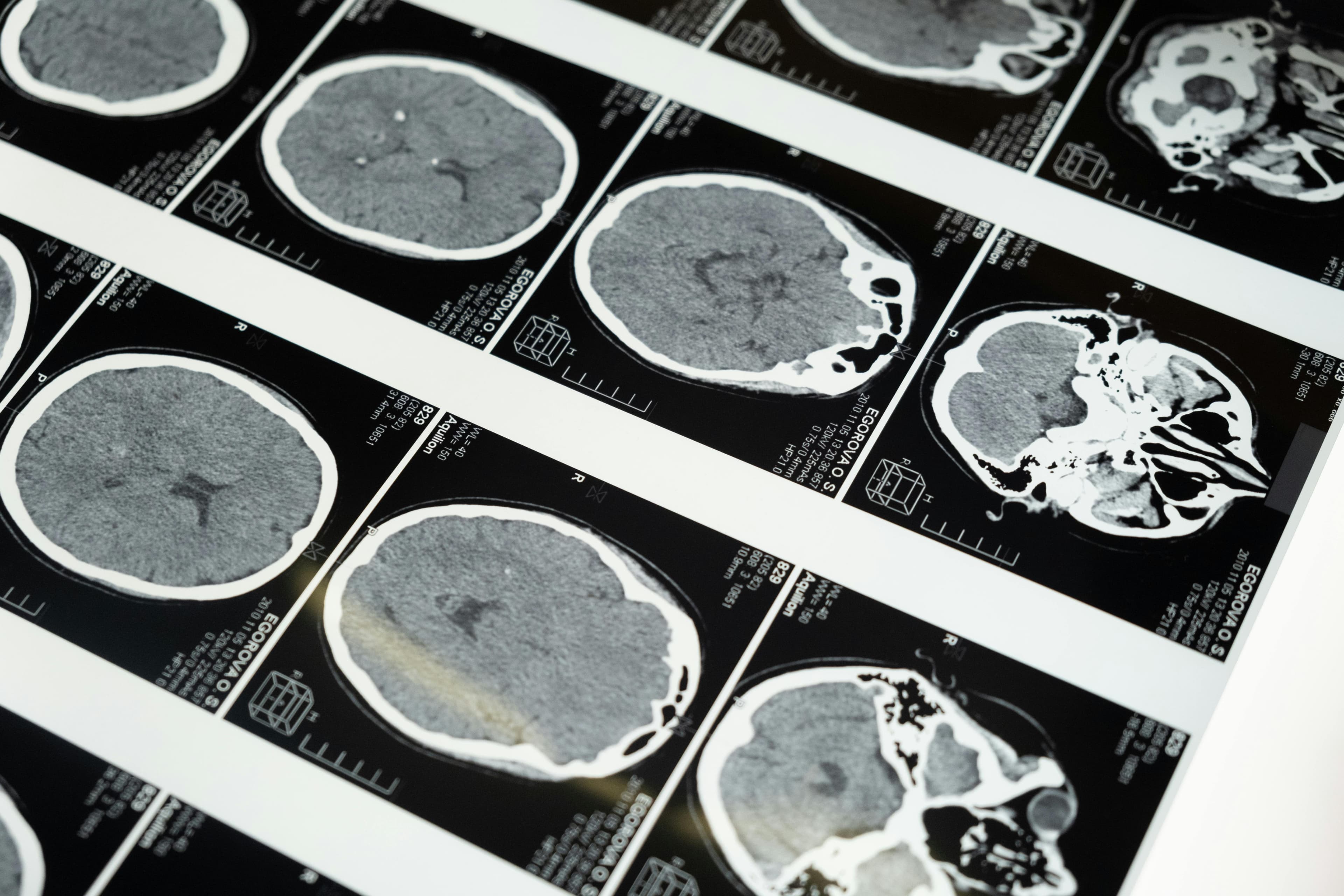 Brain scan showing the impact of algorithms on children's development